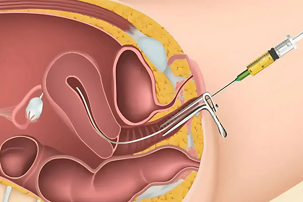 IUI Treatment
