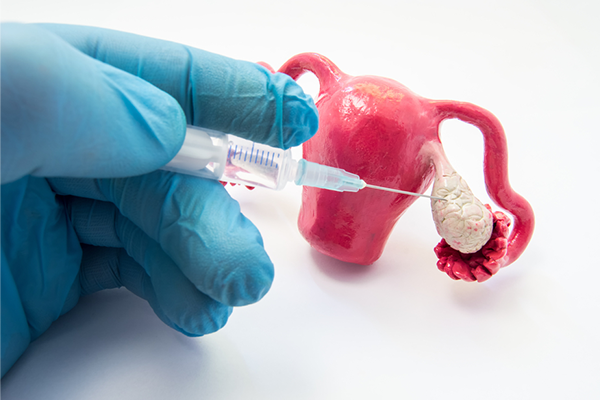 Ovulation Induction