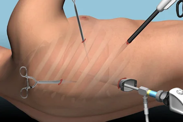 Thoracic Laparoscopy